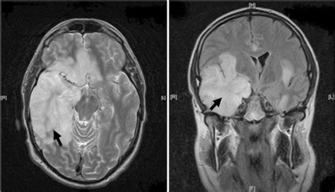 hsv encephalitis